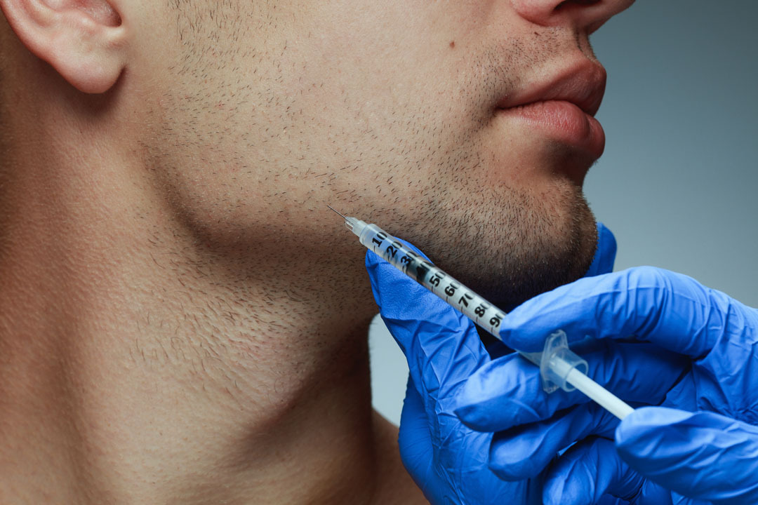 Tudo o que você precisa saber sobre preenchimento facial